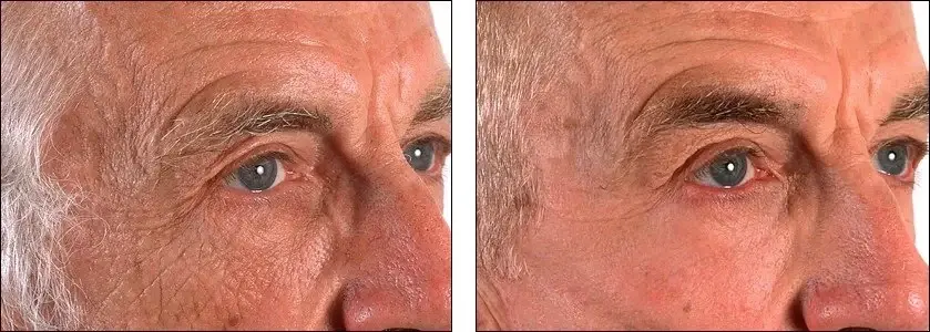 Denenberg Facial Plastic Surgery chemical peel result — Omaha, NE