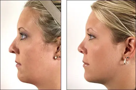 Denenberg Facial Plastic Surgery rhinoplasty result — Omaha, NE