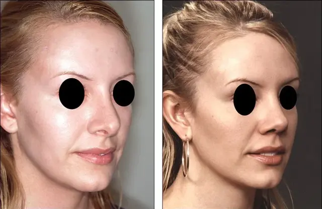 Rhinoplasty result at Denenberg Facial Plastic Surgery in Omaha, NE