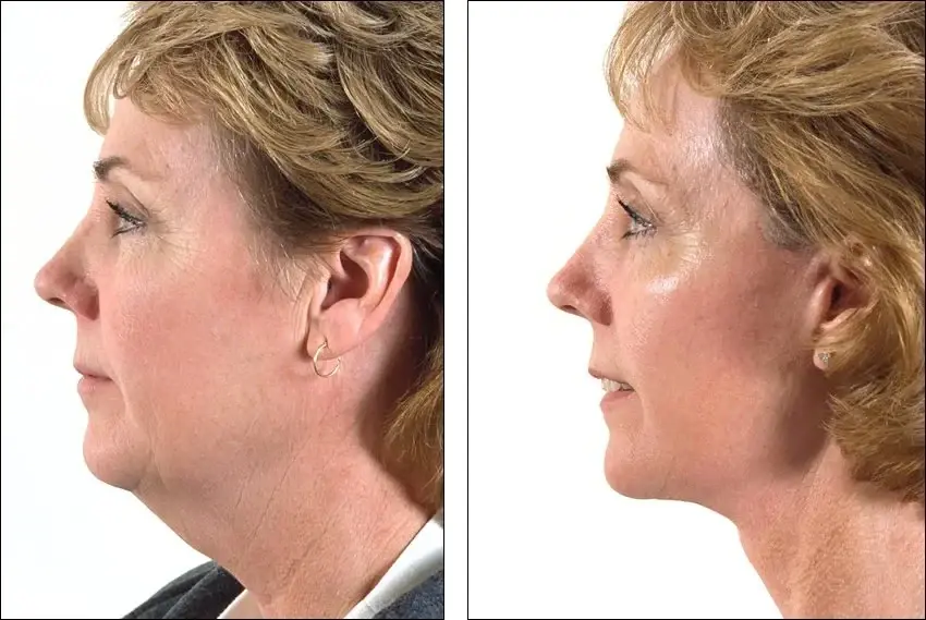 Denenberg Facial Plastic Surgery facelift result — Omaha, NE