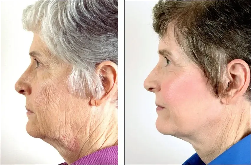 Denenberg Facial Plastic Surgery facelift result — Omaha, NE