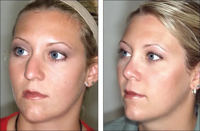 Denenberg Facial Plastic Surgery rhinoplasty result — Omaha, NE