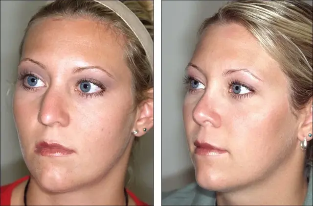 Rhinoplasty result at Denenberg Facial Plastic Surgery in Omaha, NE