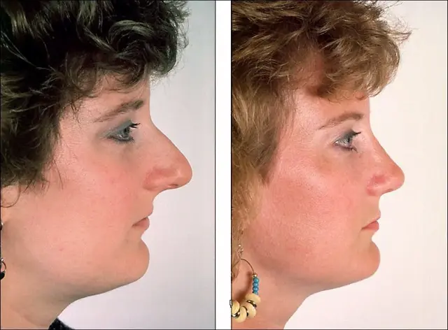 Rhinoplasty result at Denenberg Facial Plastic Surgery in Omaha, NE