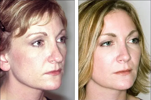 Rhinoplasty result at Denenberg Facial Plastic Surgery in Omaha, NE