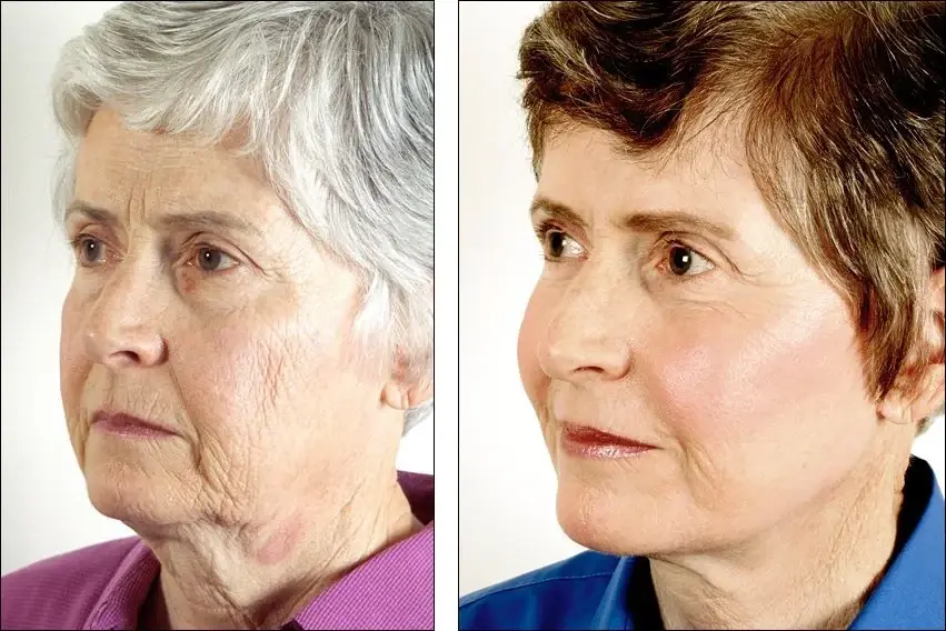 Denenberg Facial Plastic Surgery facelift result — Omaha, NE