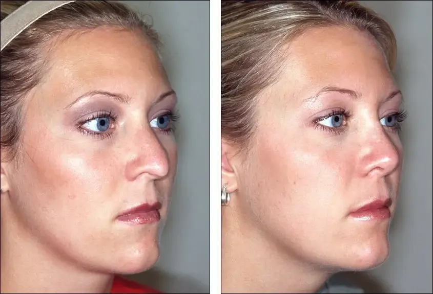 Denenberg Facial Plastic Surgery rhinoplasty result — Omaha, NE
