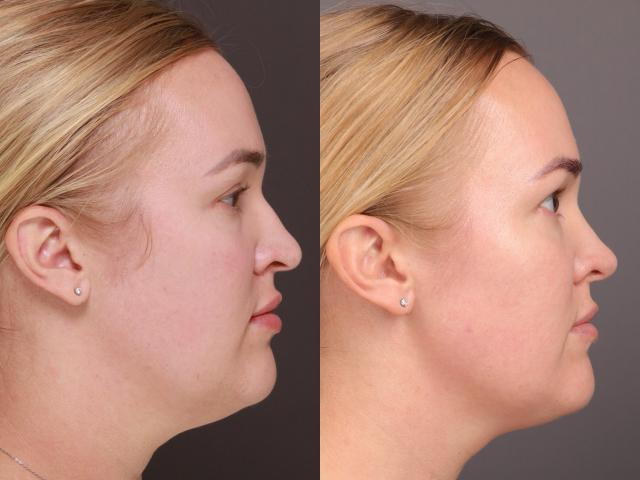 Ethnic Rhinoplasty result at Utah Facial Plastics & UFP Hair Restoration in Draper, UT