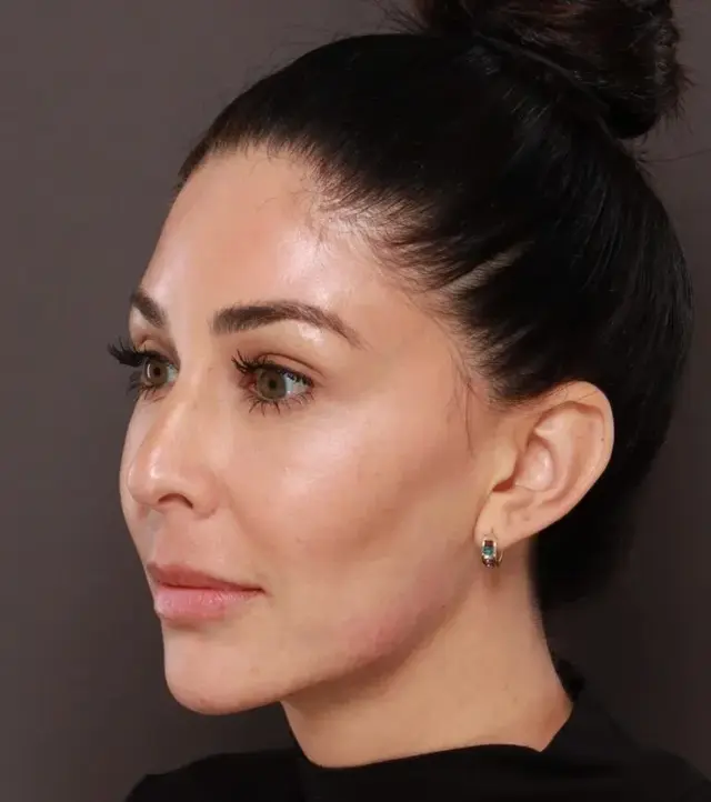 Jawline Filler after at Utah Facial Plastics & UFP Hair Restoration in Draper, UT