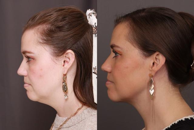 Neck Lift result at Utah Facial Plastics & UFP Hair Restoration in Draper, UT