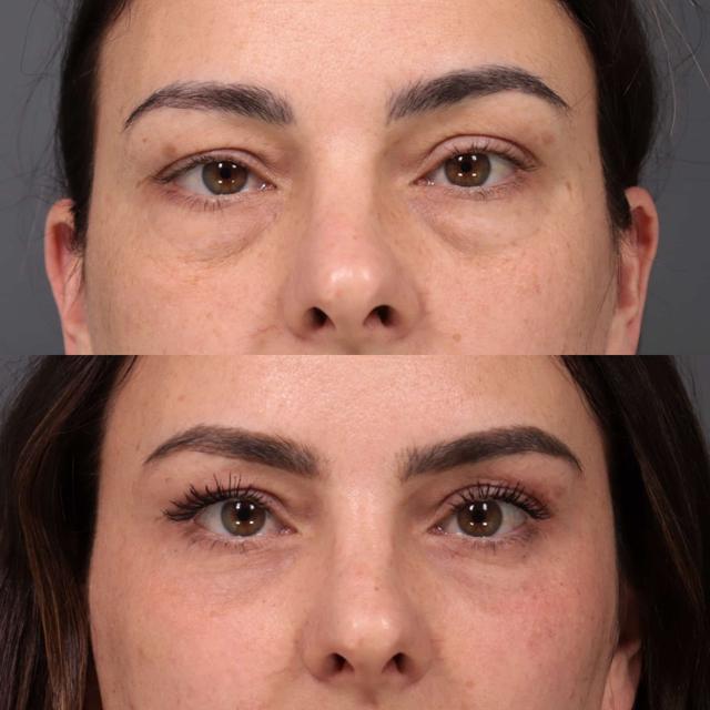 Blepharoplasty result at Utah Facial Plastics & UFP Hair Restoration in Draper, UT