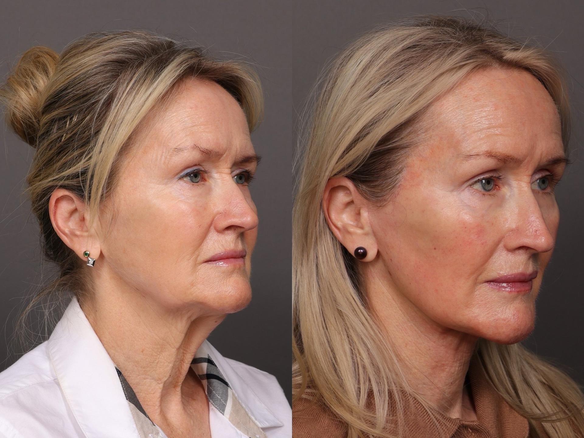 Utah Facial Plastics & UFP Hair Restoration botox result — Draper, UT