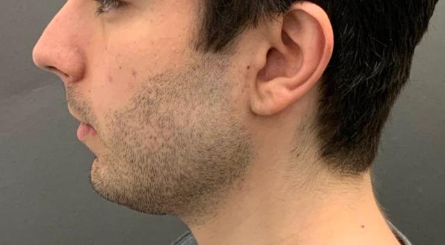 Kybella before at Utah Facial Plastics & UFP Hair Restoration in Draper, UT