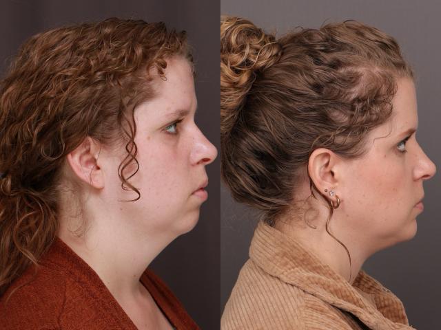 Chin Implant result at Utah Facial Plastics & UFP Hair Restoration in Draper, UT