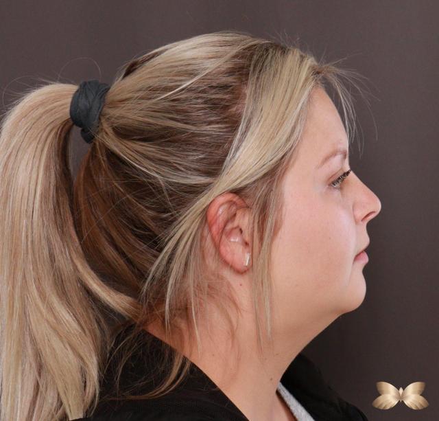 Neck Liposuction before at Utah Facial Plastics & UFP Hair Restoration in Draper, UT