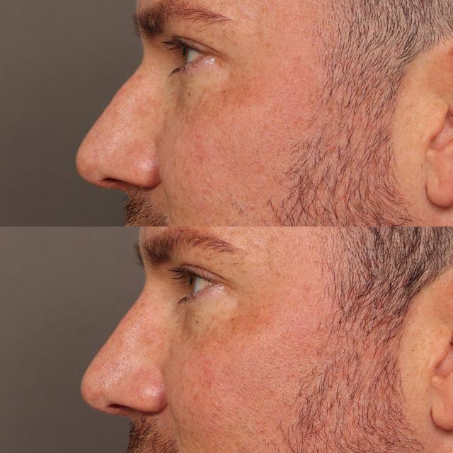 Liquid Rhinoplasty result at Utah Facial Plastics & UFP Hair Restoration in Draper, UT