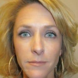 Dermal Fillers before at Utah Facial Plastics & UFP Hair Restoration in Draper, UT