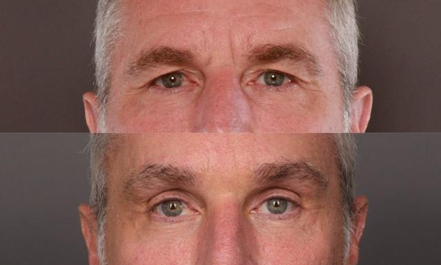 Brow Lift result at Utah Facial Plastics & UFP Hair Restoration in Draper, UT