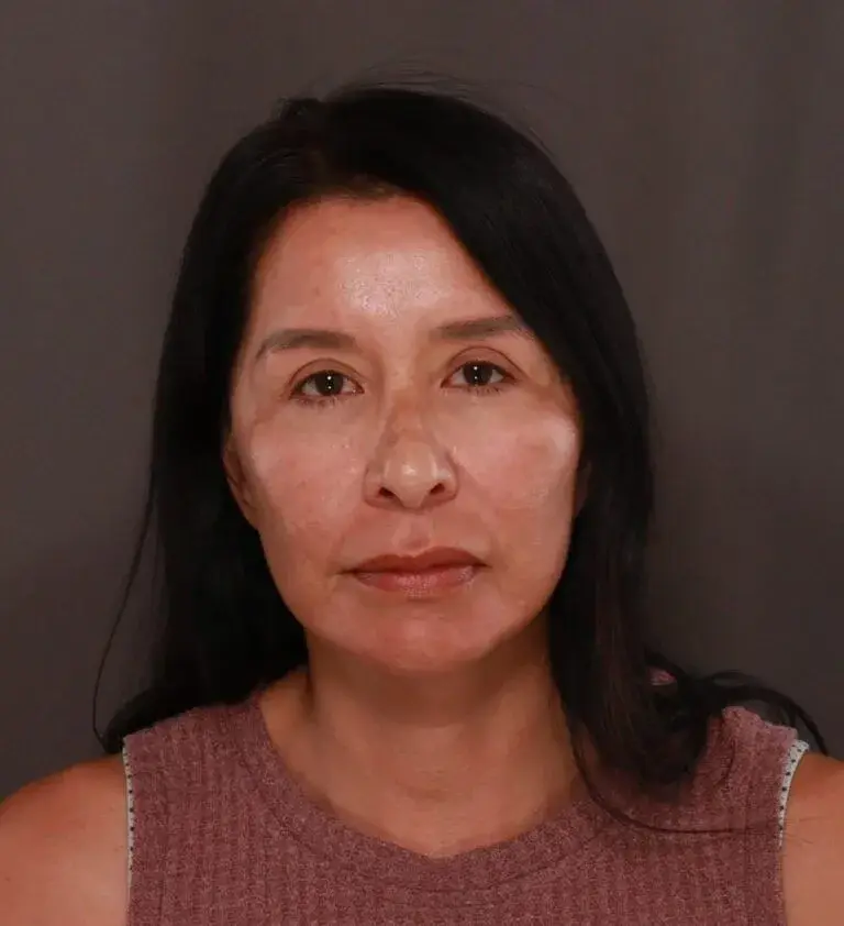 Utah Facial Plastics & UFP Hair Restoration facelift after — Draper, UT