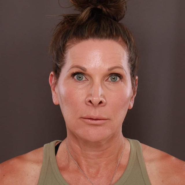 Brow Lift before at Utah Facial Plastics & UFP Hair Restoration in Draper, UT