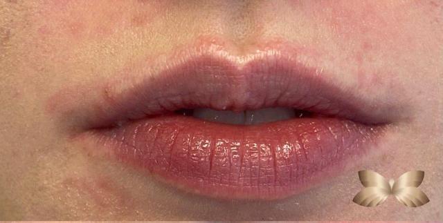 Lip Filler before at Utah Facial Plastics & UFP Hair Restoration in Draper, UT