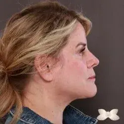 Blepharoplasty after at Utah Facial Plastics & UFP Hair Restoration in Salt Lake City, UT