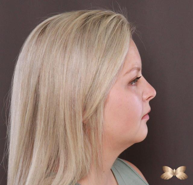 Neck Liposuction after at Utah Facial Plastics & UFP Hair Restoration in Draper, UT