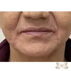 Facelift after at Utah Facial Plastics & UFP Hair Restoration in Salt Lake City, UT