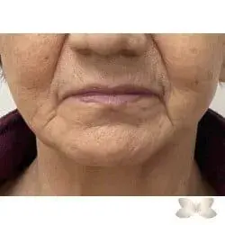 Facelift before at Utah Facial Plastics & UFP Hair Restoration in Salt Lake City, UT
