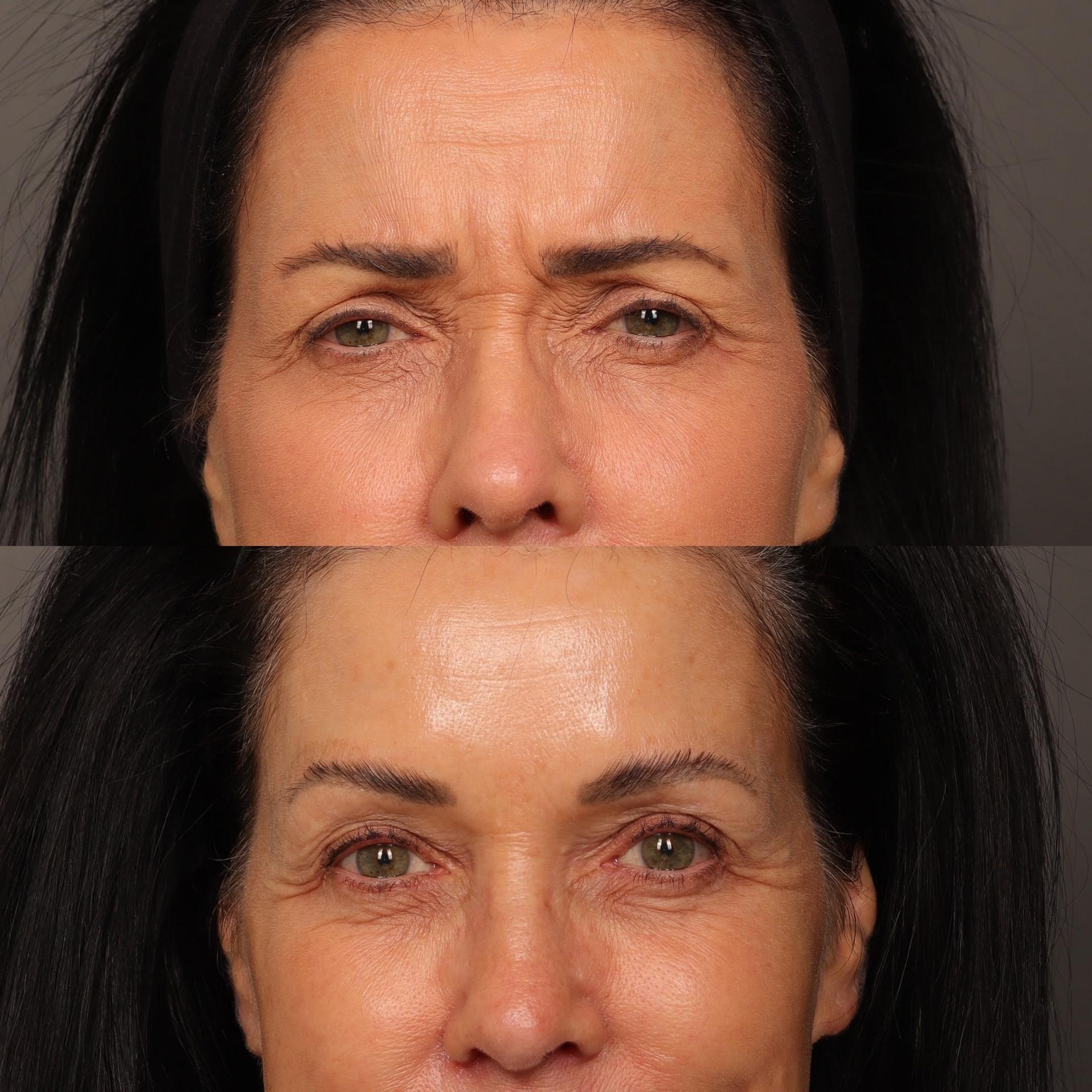 Utah Facial Plastics & UFP Hair Restoration botox result — Draper, UT