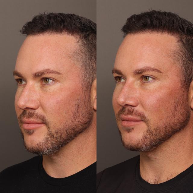 Liquid Rhinoplasty result at Utah Facial Plastics & UFP Hair Restoration in Draper, UT