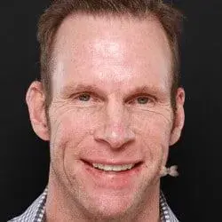 Utah Facial Plastics & UFP Hair Restoration botox after — Salt Lake City, UT