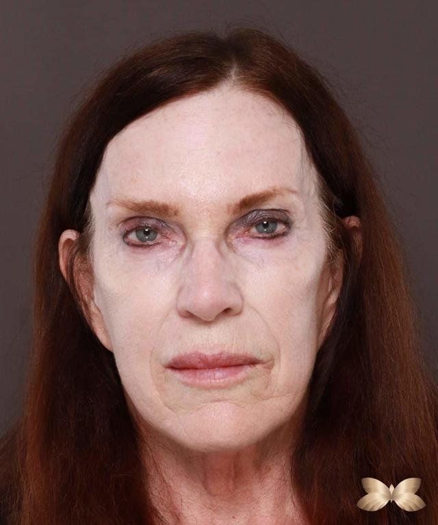 Dermal Fillers before at Utah Facial Plastics & UFP Hair Restoration in Draper, UT
