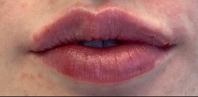 Lip Filler after at Utah Facial Plastics & UFP Hair Restoration in Draper, UT