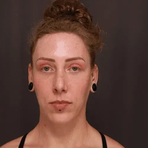 Brow Lift after at Utah Facial Plastics & UFP Hair Restoration in Draper, UT