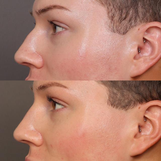 Liquid Rhinoplasty result at Utah Facial Plastics & UFP Hair Restoration in Draper, UT