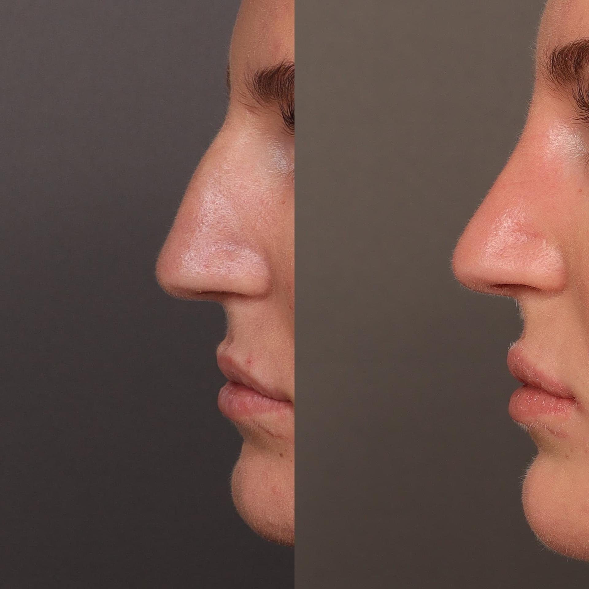 Utah Facial Plastics & UFP Hair Restoration rhinoplasty result — Draper, UT