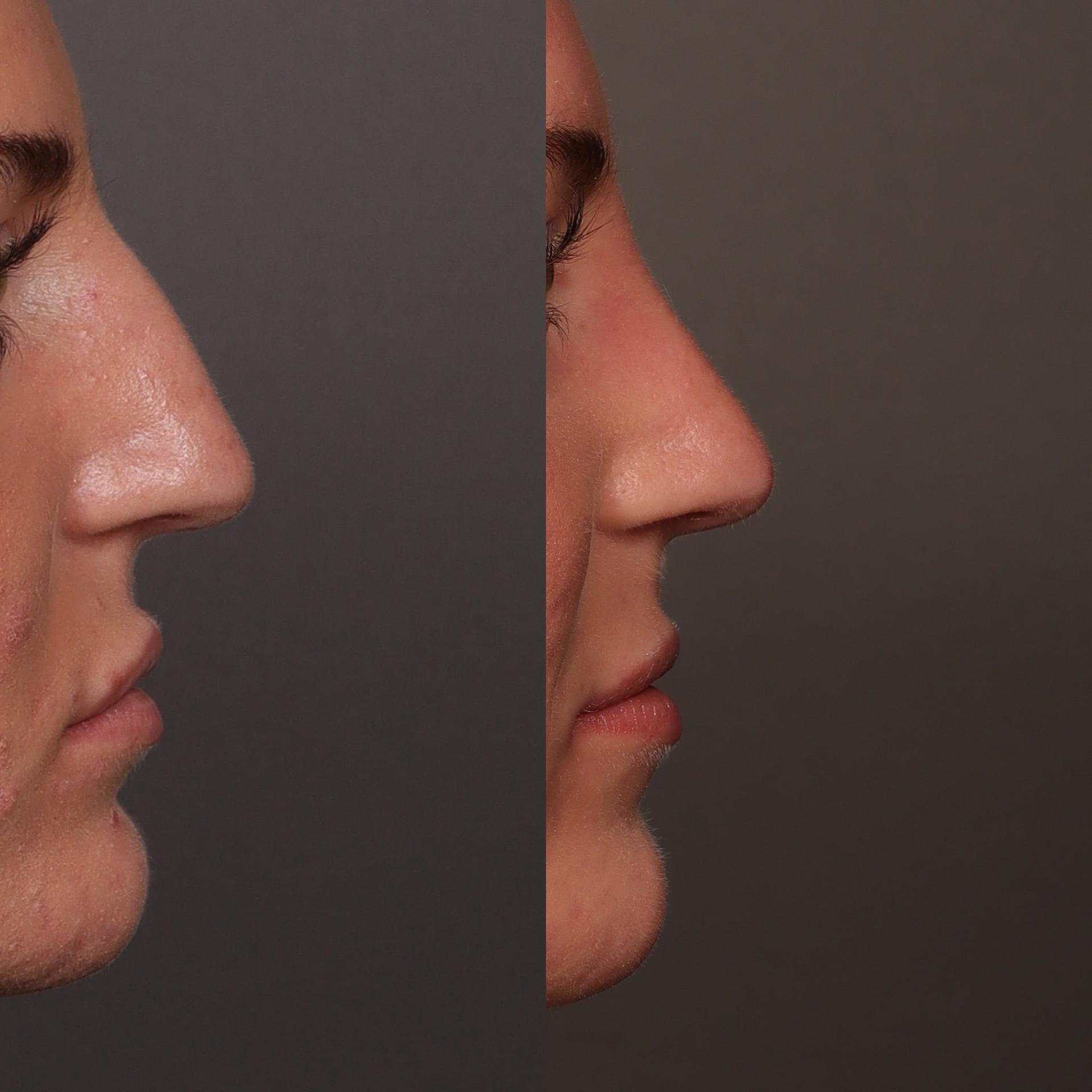 Utah Facial Plastics & UFP Hair Restoration rhinoplasty result — Draper, UT