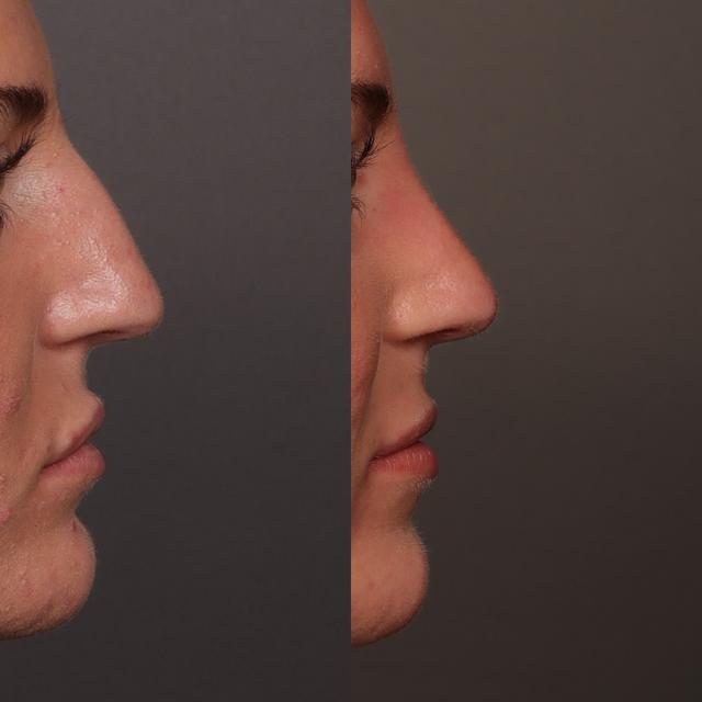 Rhinoplasty result at Utah Facial Plastics & UFP Hair Restoration in Draper, UT