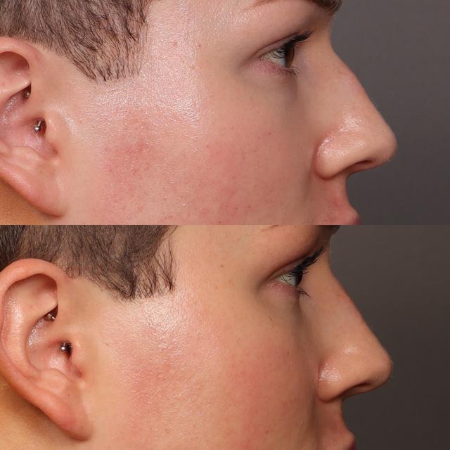 Liquid Rhinoplasty result at Utah Facial Plastics & UFP Hair Restoration in Draper, UT