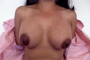Nouri Ghorbani, MD breast augmentation after — Walnut Creek, CA