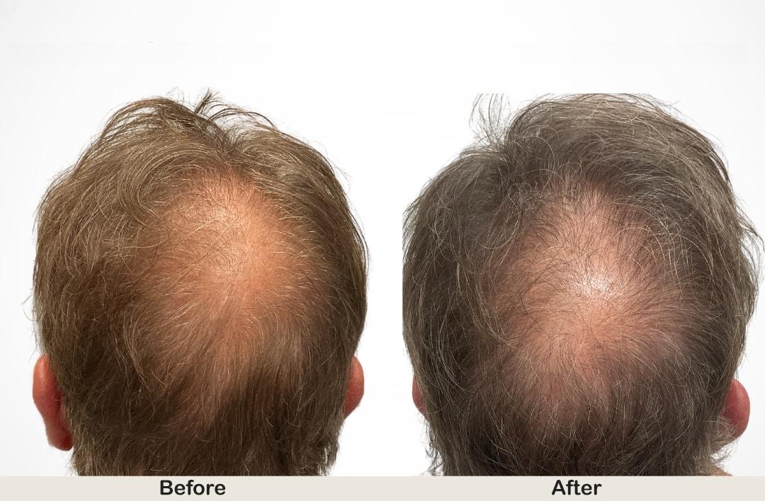Franklin Dermatology Group hair restoration result — Franklin, TN