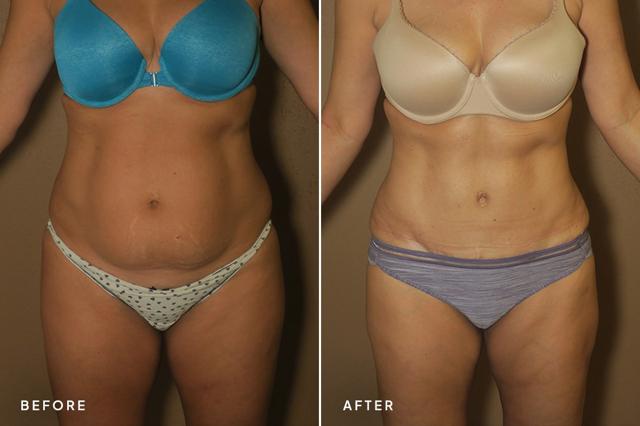 Tummy Tuck result at New Horizons Center for Cosmetic Surgery (Gregory A. Turowski, MD) in Skokie, IL