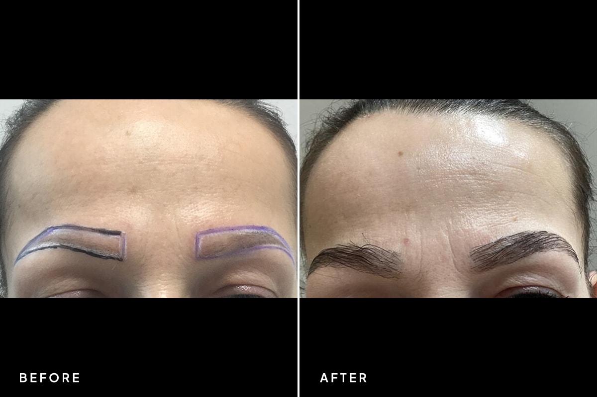 New Horizons Center for Cosmetic Surgery (Gregory A. Turowski, MD) eyebrow transplant result — Skokie, IL