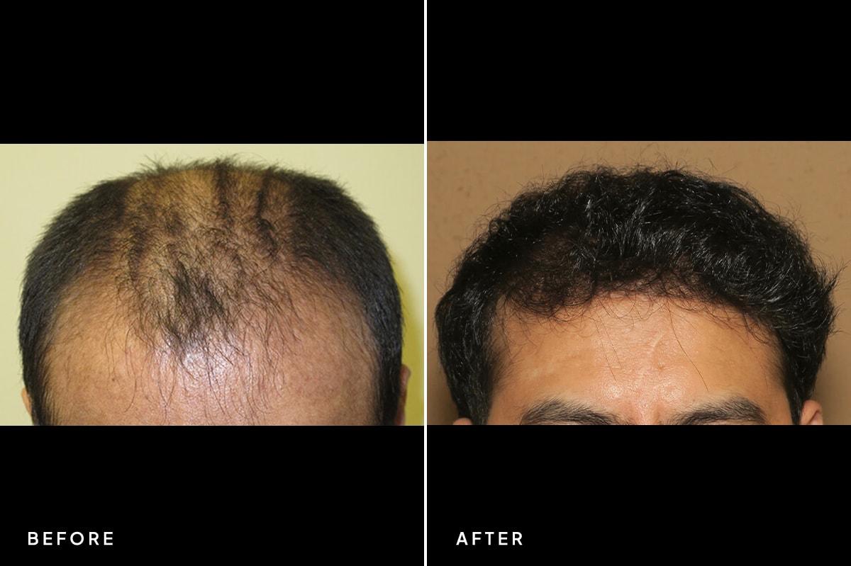 New Horizons Center for Cosmetic Surgery (Gregory A. Turowski, MD) hair restoration result — Skokie, IL