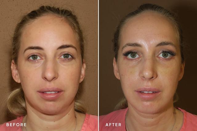 Chin Implant result at New Horizons Center for Cosmetic Surgery (Gregory A. Turowski, MD) in Skokie, IL