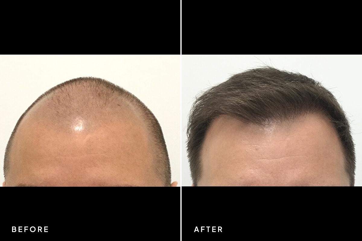 New Horizons Center for Cosmetic Surgery (Gregory A. Turowski, MD) hair restoration result — Skokie, IL