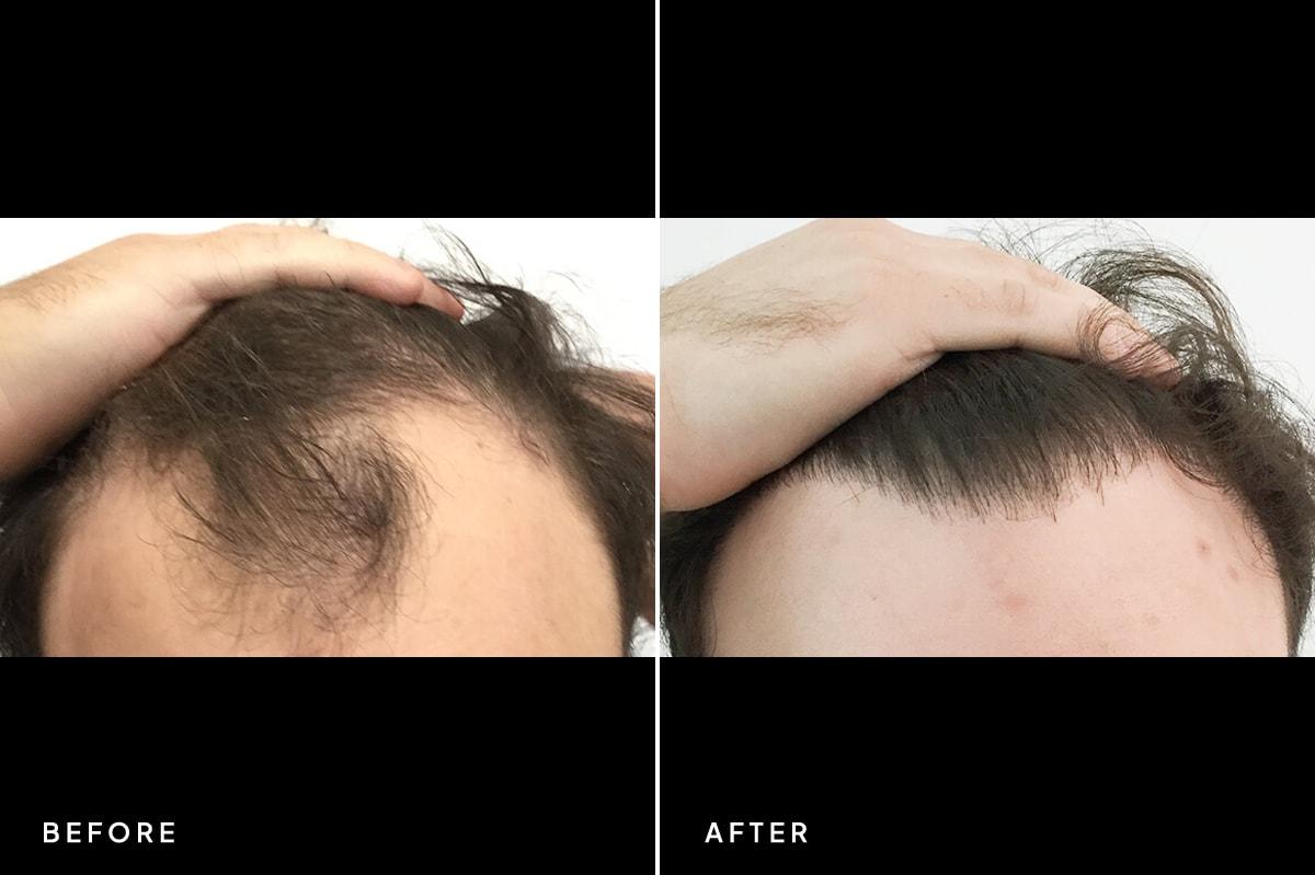 New Horizons Center for Cosmetic Surgery (Gregory A. Turowski, MD) hair restoration result — Skokie, IL