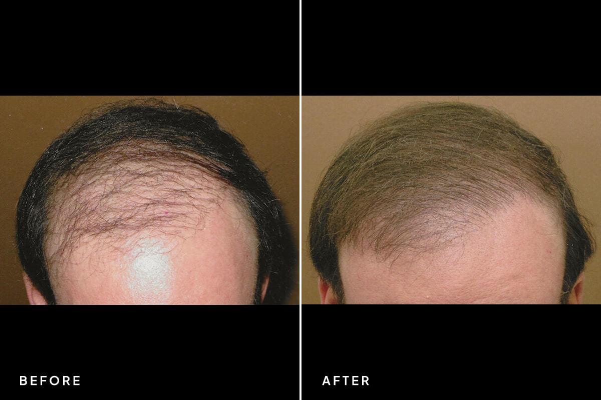 New Horizons Center for Cosmetic Surgery (Gregory A. Turowski, MD) hair restoration result — Skokie, IL