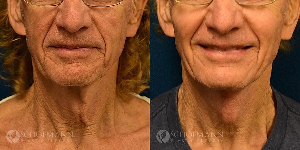 Dermacare Encinitas at Schoemann Plastic Surgery neck lift result — Encinitas, CA